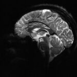 Yapay Zeka ile Epilepsi Tedavisinde Yeni Bir Dönem: Gizli Lezyonların İzinde